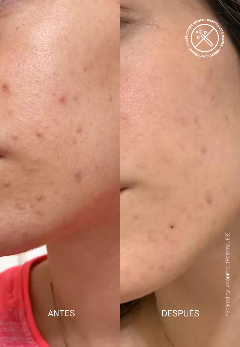 PIE Acne Red Spot Fading Treatment - Image 8